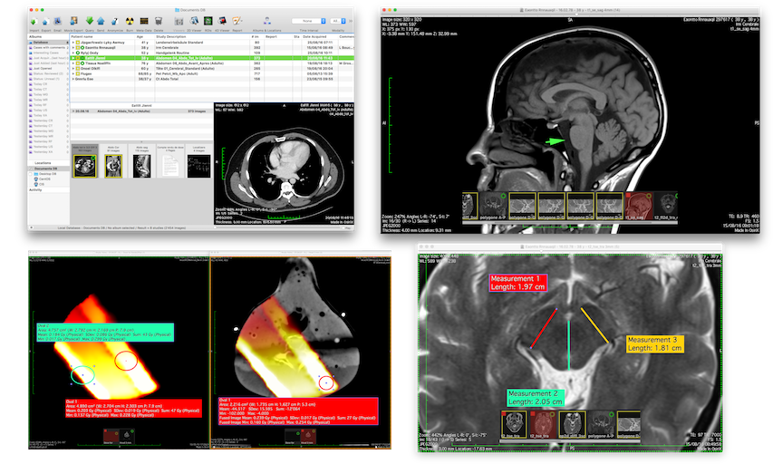 what is osirix lite