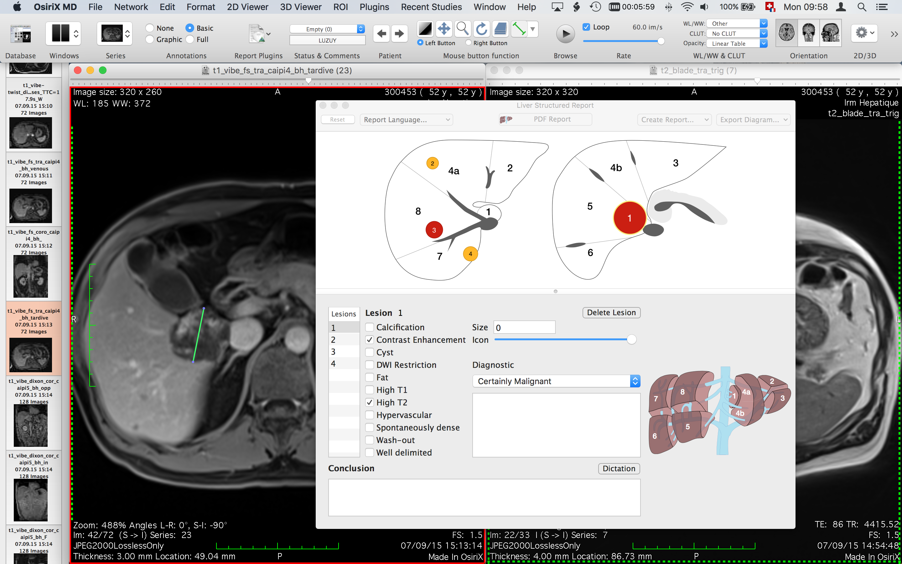 osirix md software