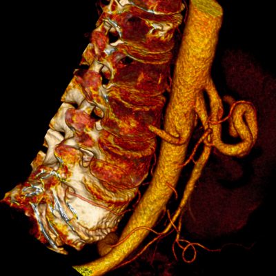 Celiac Artery dataset