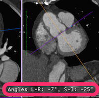 L-R and S-I Angles