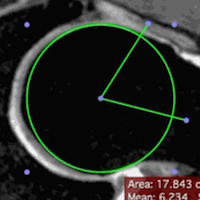 Alpha Angle ROI