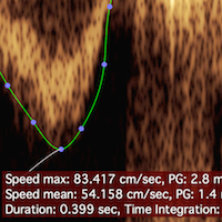 New Ultrasound Tools for Cardiology