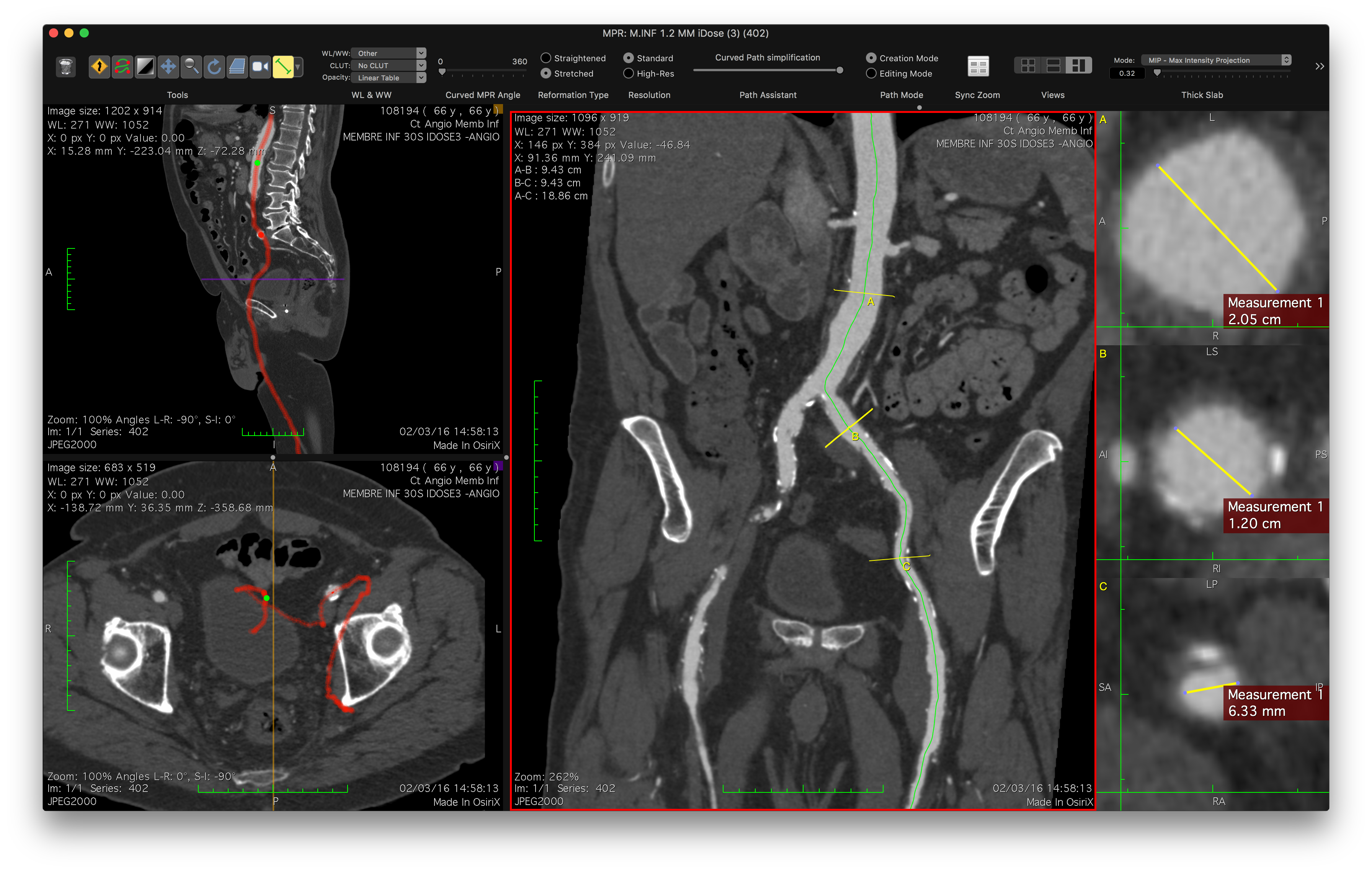 osirix windows ecocardiography