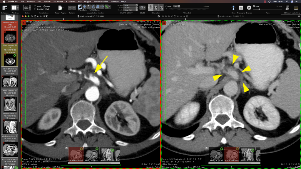 Enlargement-Infiltration image