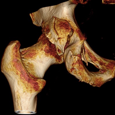 Acetabulum Fracture dataset