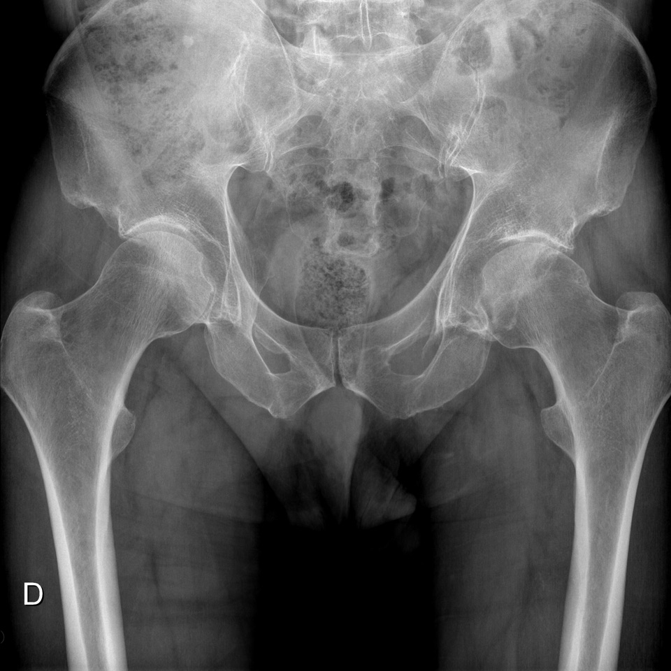 OsiriX DICOM Viewer | Case Report : Acetabulum fracture in a 65 years
