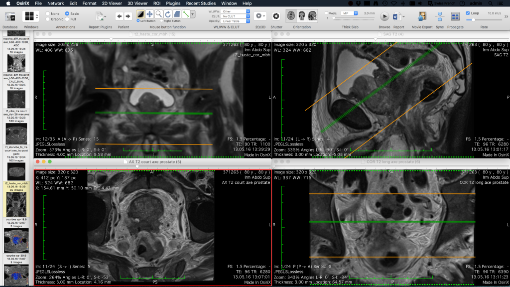 osirix md sort by te