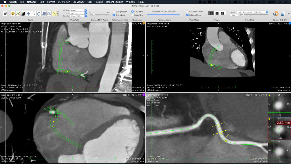 compare osirix lite osirix md