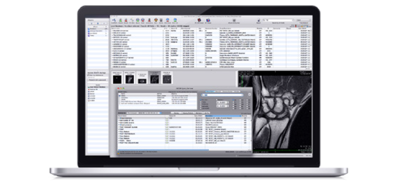 osirix lite segmentation